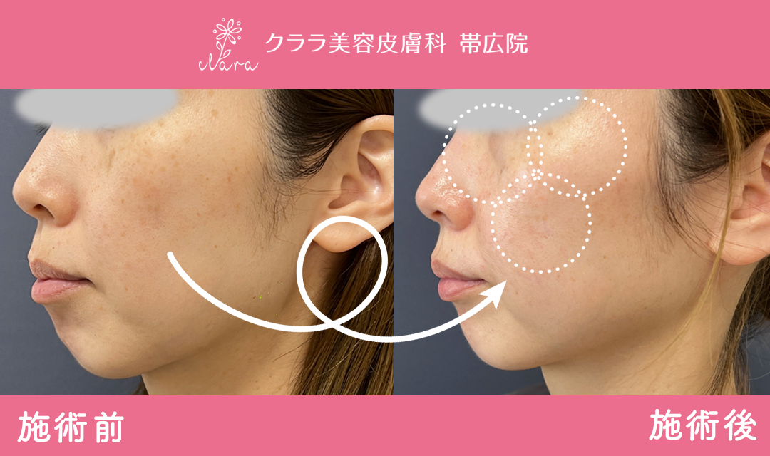 ピコスポットビフォーアフター