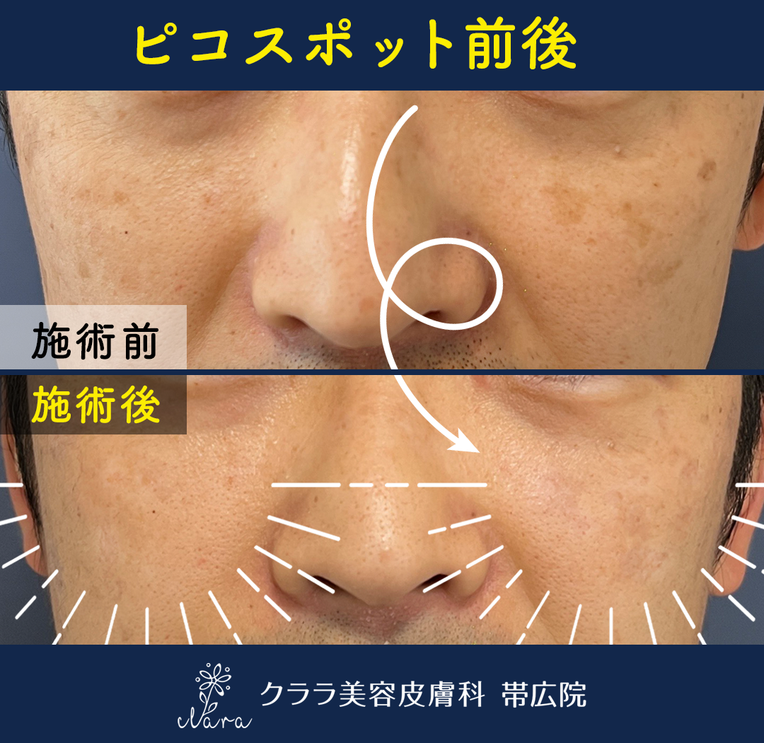 ピコスポットビフォーアフター