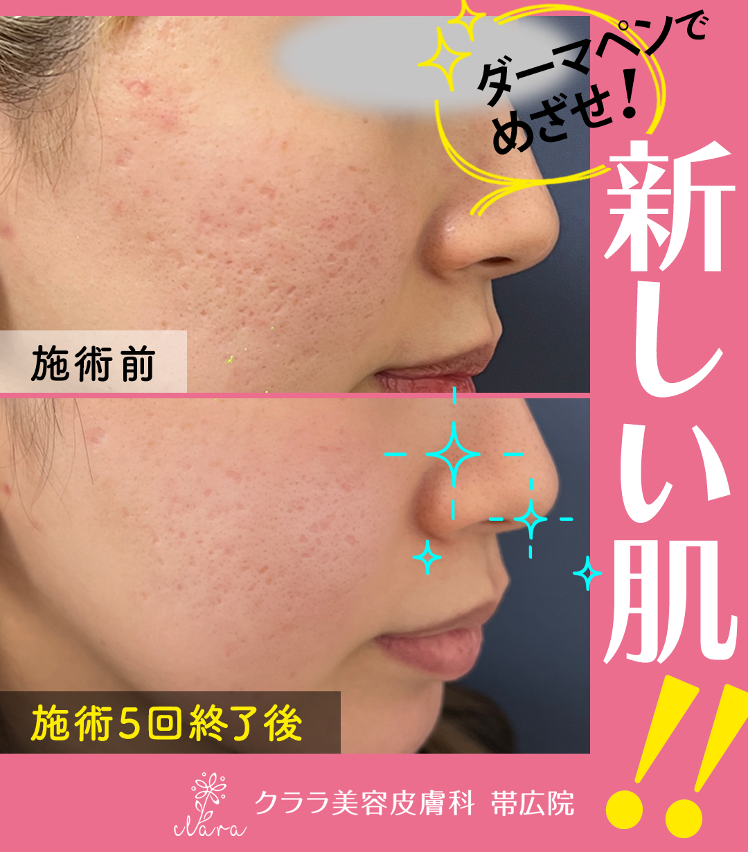 ダーマペンで新しい肌へ！