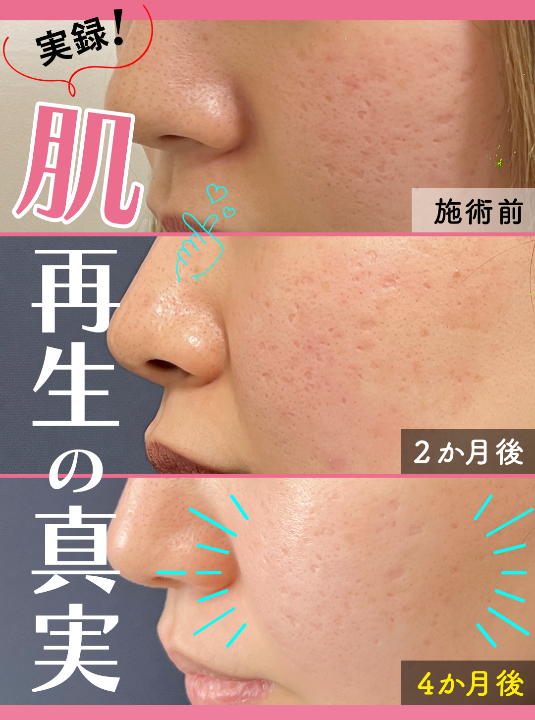 ダーマペンビフォーアフター