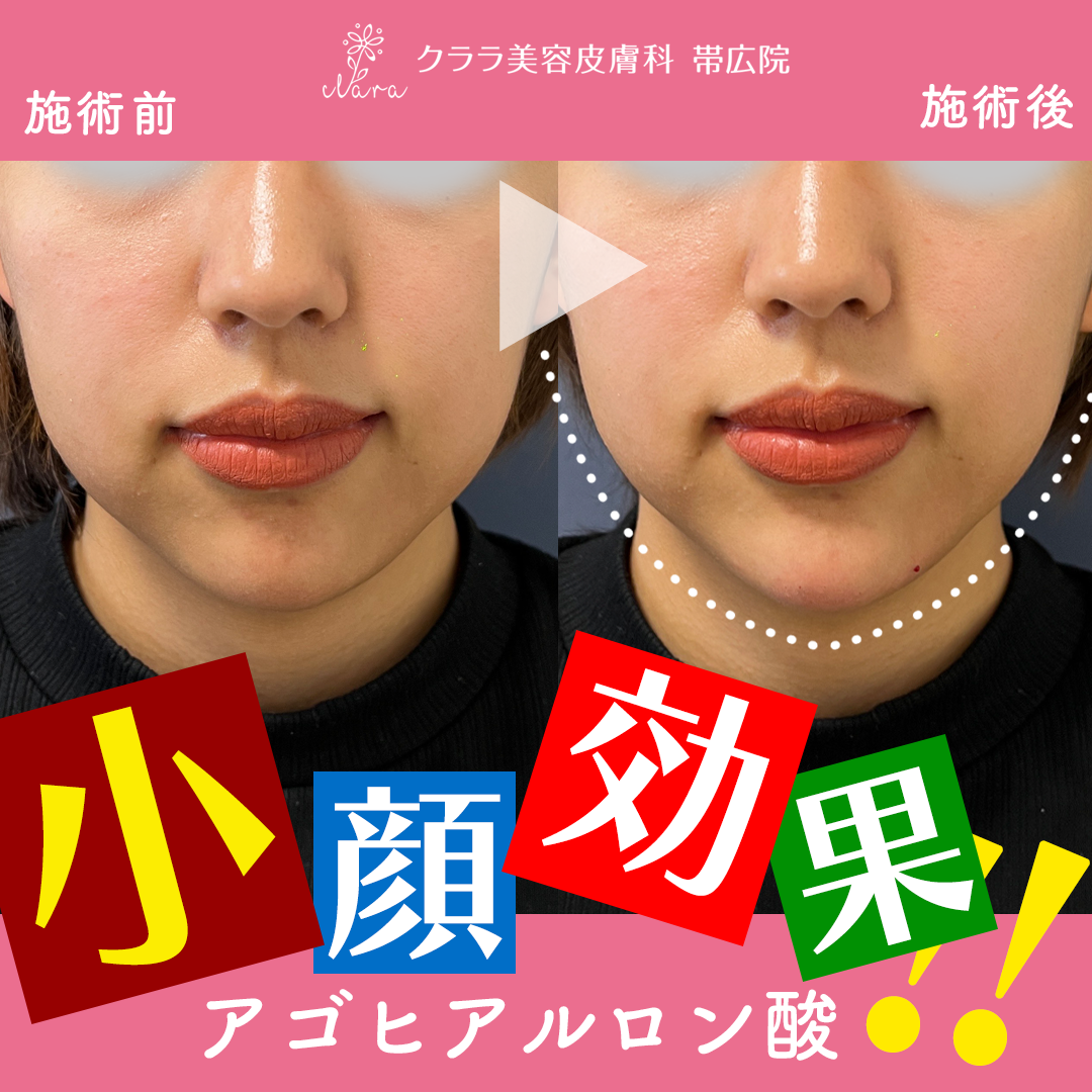 アゴヒアルロン酸で小顔に！