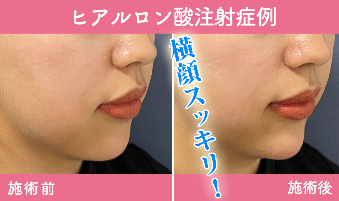 ヒアルロン酸注入症例