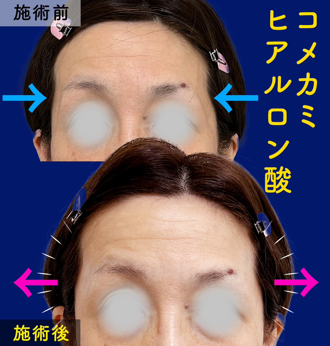 ヒアルロン酸注入症例