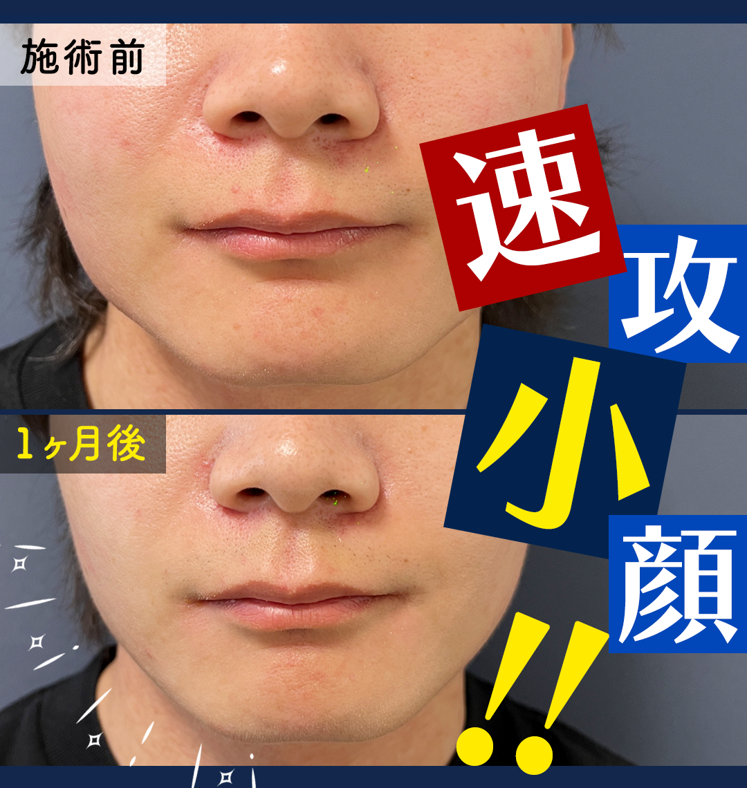 メンズ小顔！エラボトックス症例