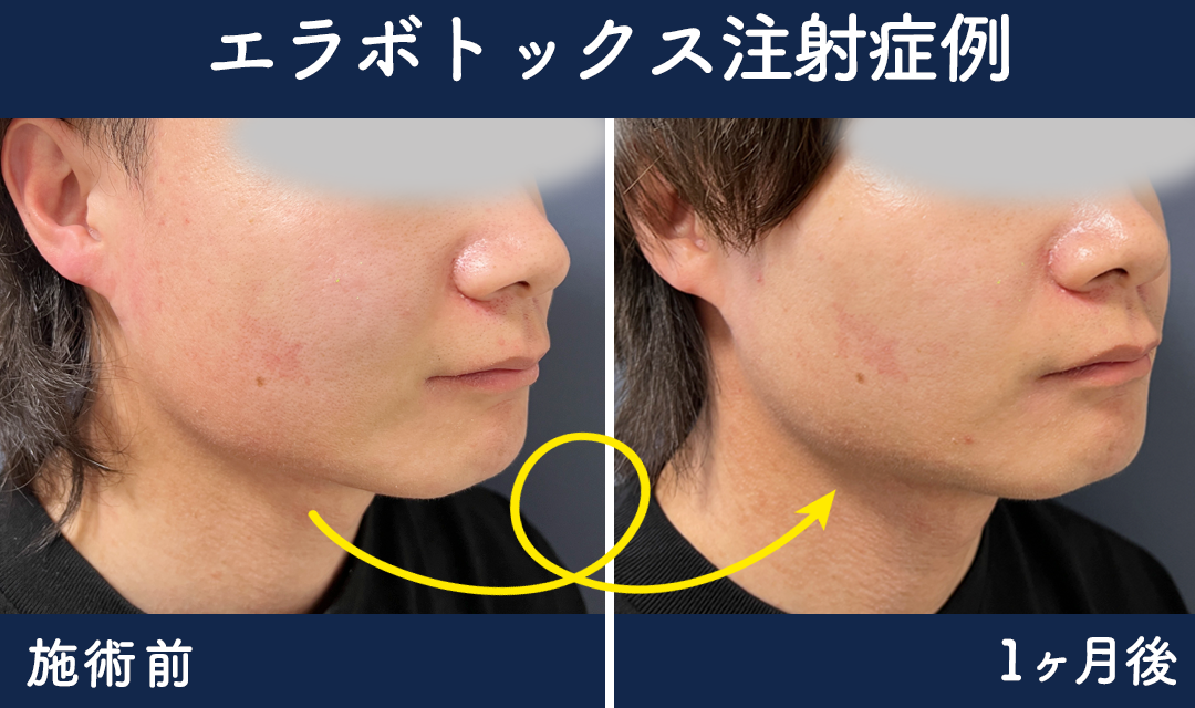 メンズ小顔！エラボトックス症例