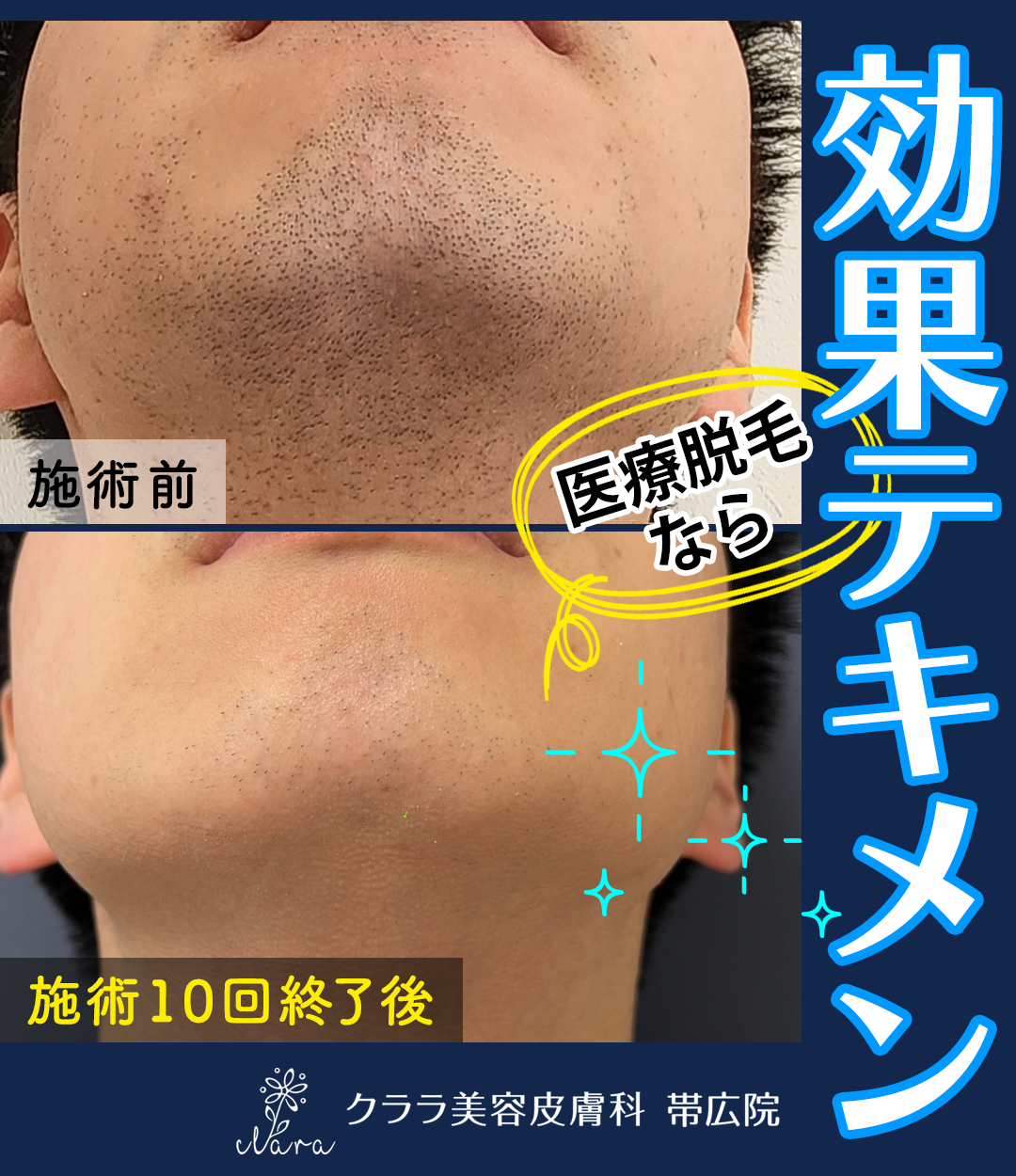 メンズ医療脱毛