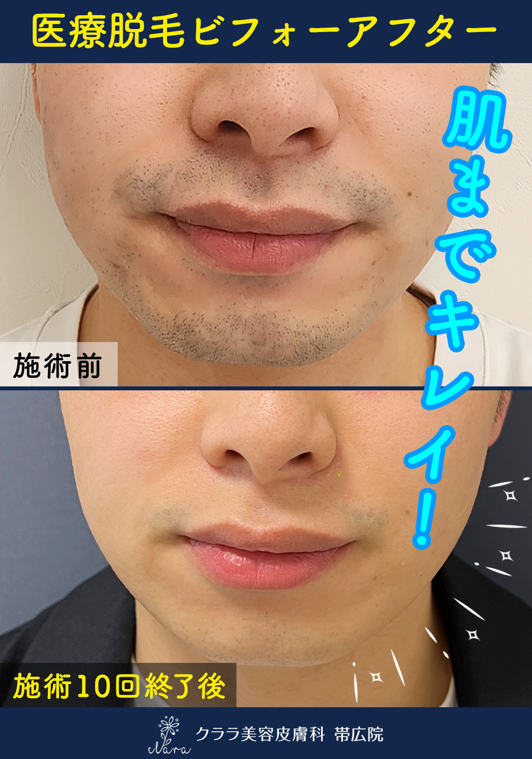 クララ 医療レーザー脱毛ビフォーアフター