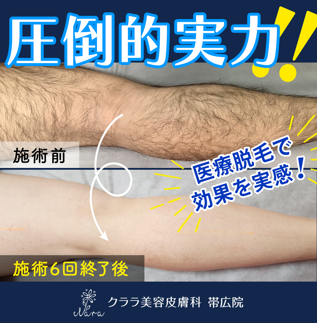 クララ メンズ脱毛