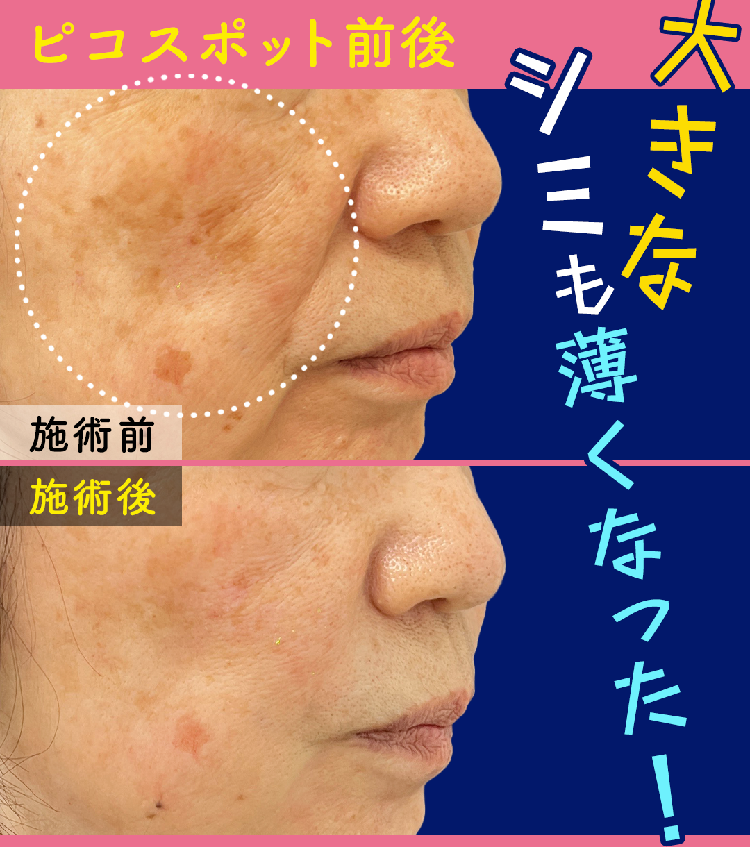 シミ・肝斑治療にピコスポット