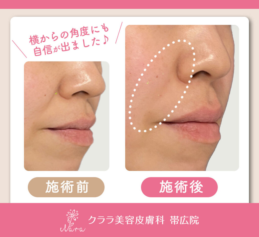 ほうれい線にはヒアルロン酸注入