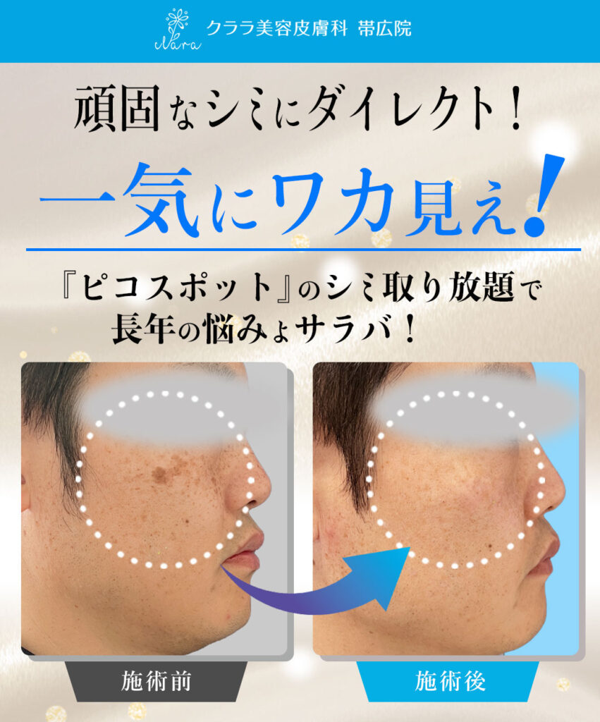 ピコスポットレーザー取り放題