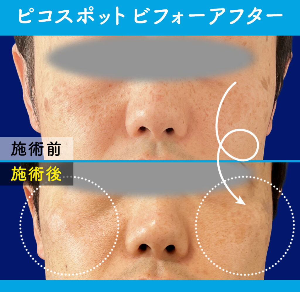 ピコスポットレーザー取り放題　ビフォーアフター