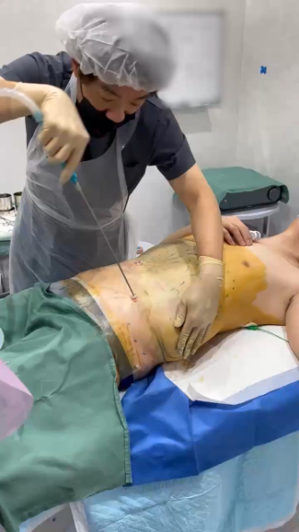 脂肪吸引施術