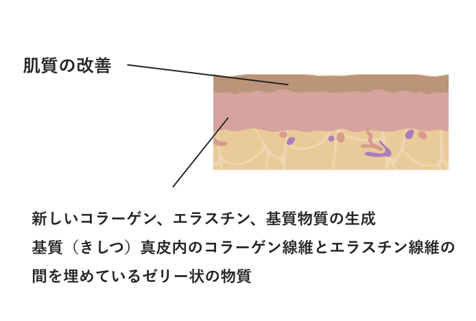 Vリフトのしくみ