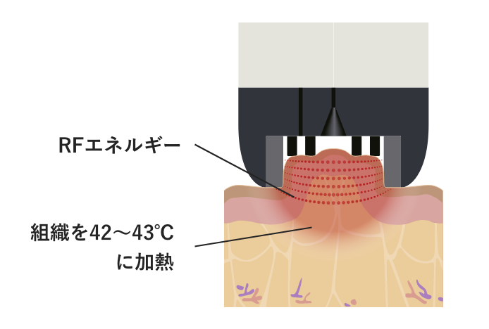 Vリフトのしくみ