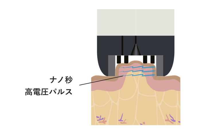 Vリフトのしくみ