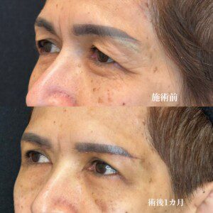 眉下リフトモニター症例