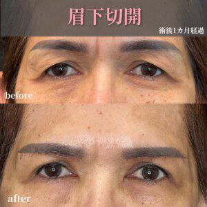 眉下リフトモニター症例