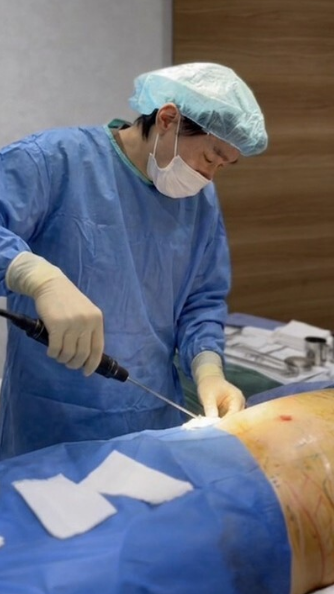 脂肪吸引施術
