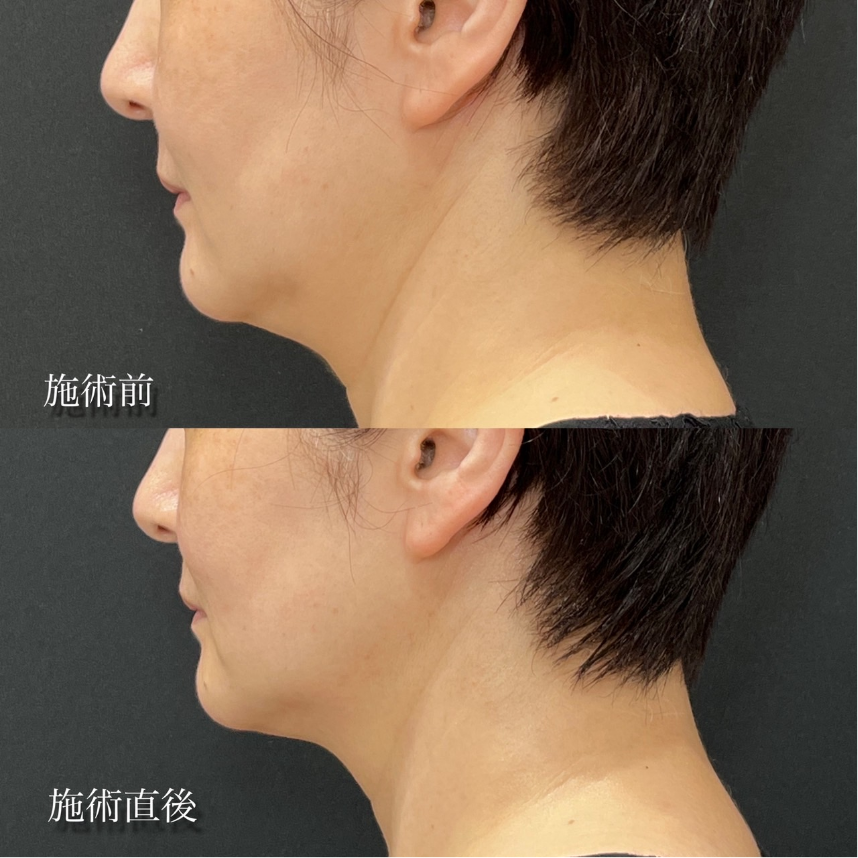 あご下＋エラ下