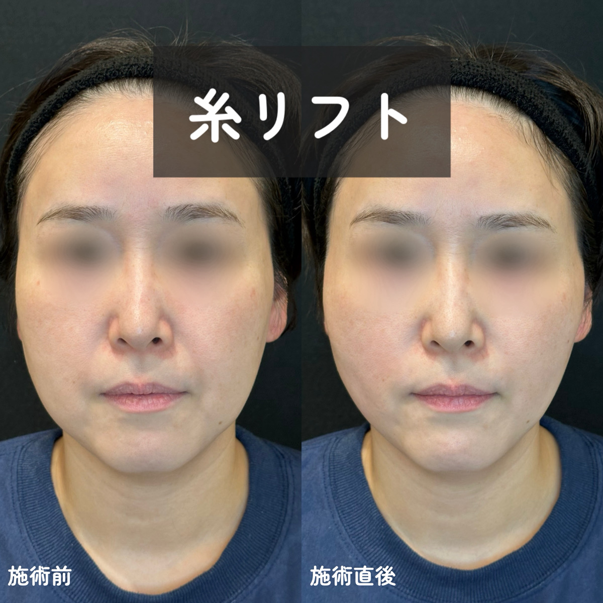 CLAIA クララジャパン 美顔器 リフトアクティブプロ 糸リフト | 新着情報 | クララビューティクリニック高崎院